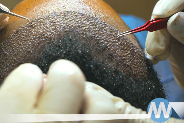 AFRO Hair Transplant in Türkiye