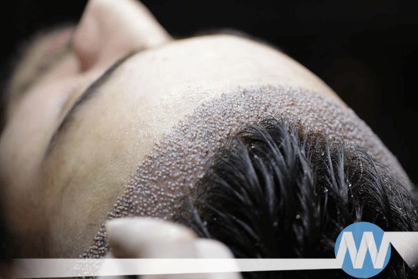 Unshaven Hair Transplant in Türkiye